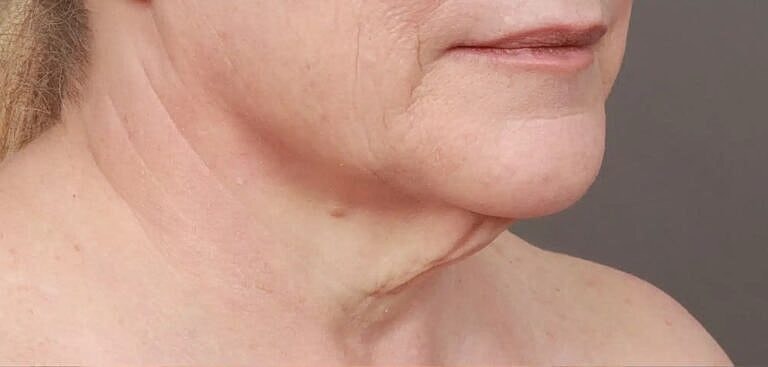 Facial Fat Transfer Before & After