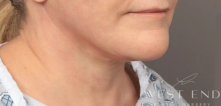 Facial Fat Transfer Before & After