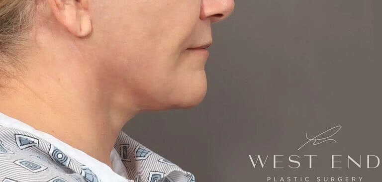 Facial Fat Transfer Before & After