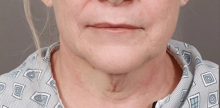 Facial Fat Transfer Before & After