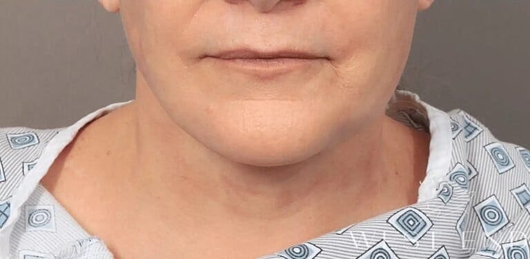 Facial Fat Transfer Before & After