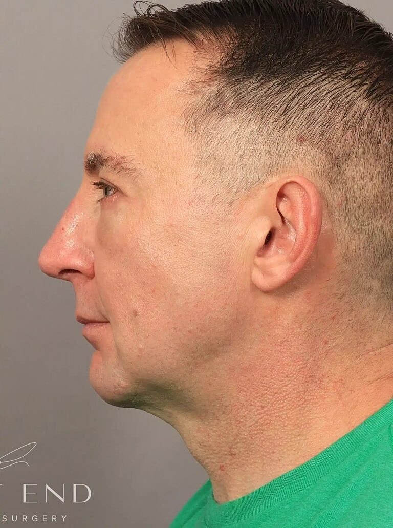 Facial Fat Transfer Before & After