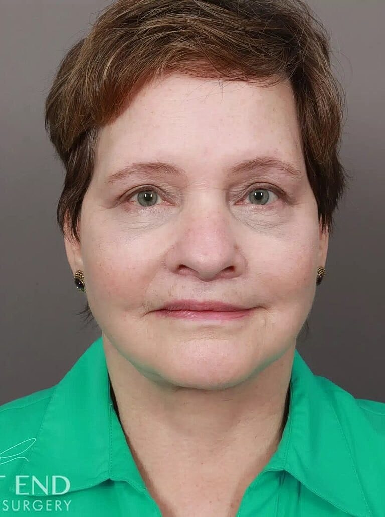 Facial Fat Transfer Before & After