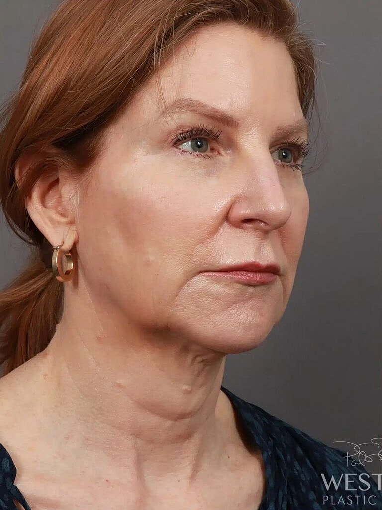 Facial Fat Transfer Before & After