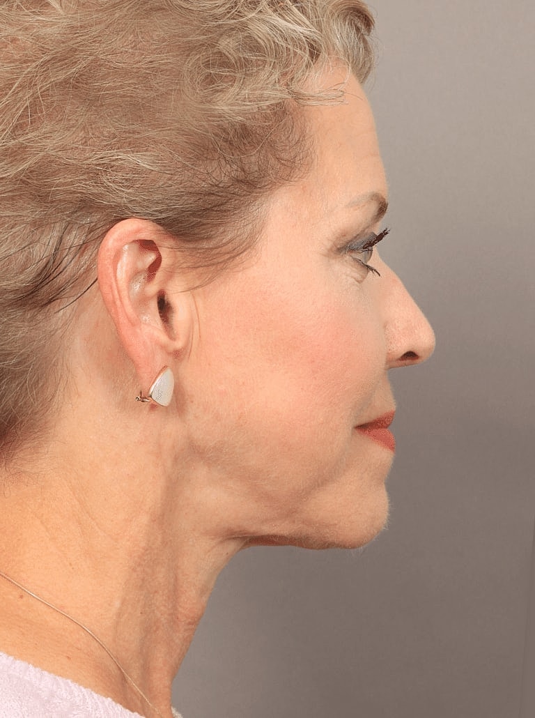 Facial Fat Transfer Before & After