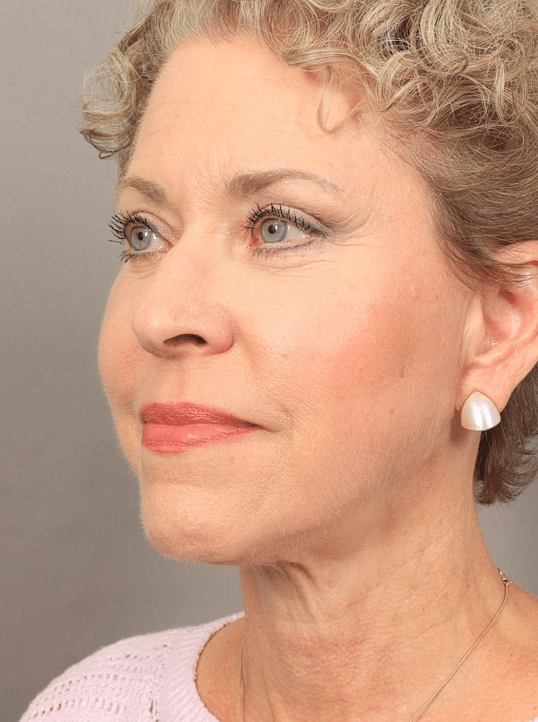 Facial Fat Transfer Before & After