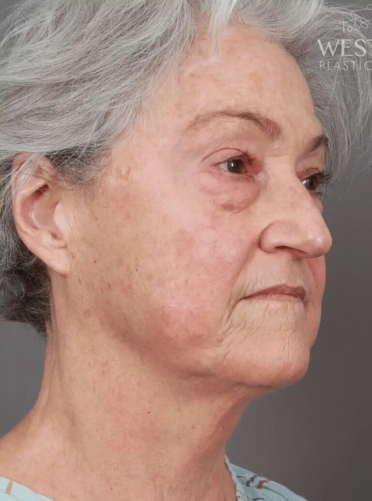 Facial Fat Transfer Before & After