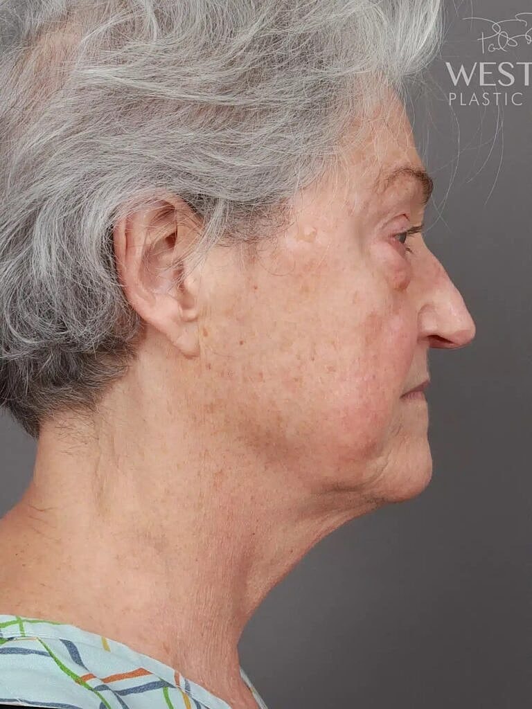 Facial Fat Transfer Before & After