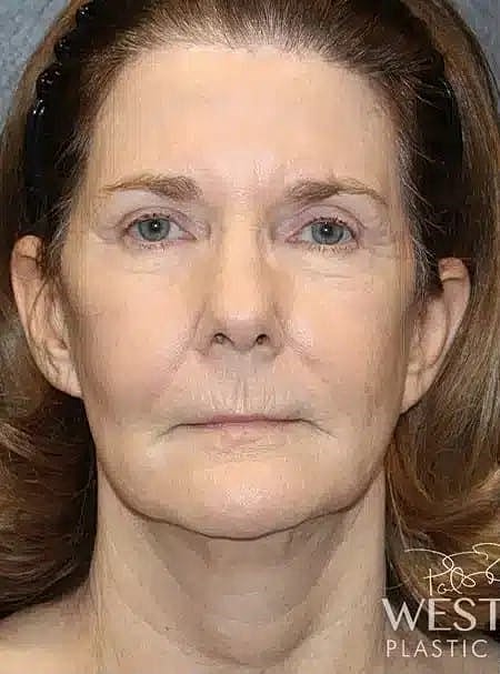 Facial Fat Transfer Before & After