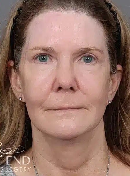 Facial Fat Transfer Before & After