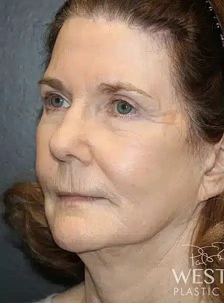 Facial Fat Transfer Before & After