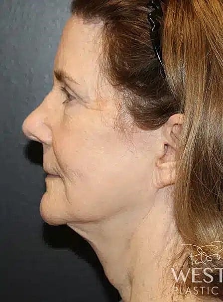 Facial Fat Transfer Before & After