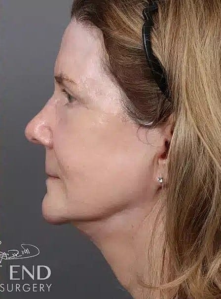 Facial Fat Transfer Before & After