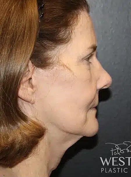 Facial Fat Transfer Before & After