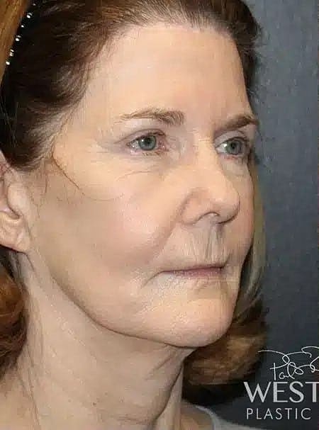 Facial Fat Transfer Before & After