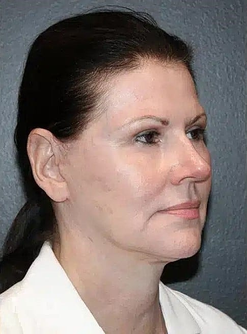 Facial Fat Transfer Before & After