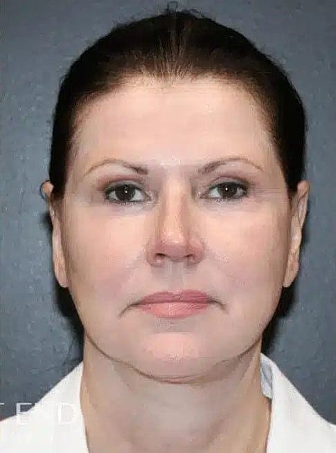 Facial Fat Transfer Before & After