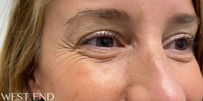 Facial Fat Transfer Before & After