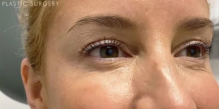 Facial Fat Transfer Before & After