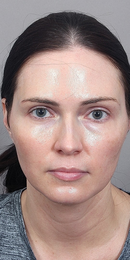 Facial Fat Transfer Before & After