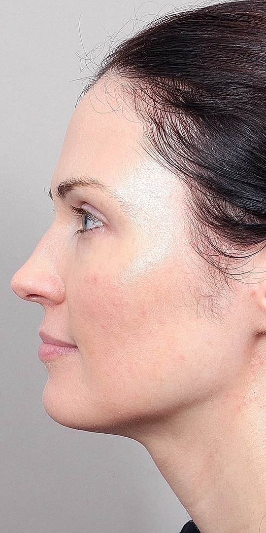 Facial Fat Transfer Before & After