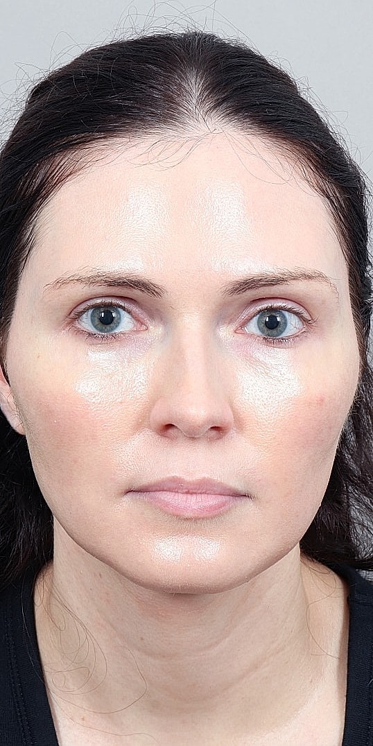 Facial Fat Transfer Before & After