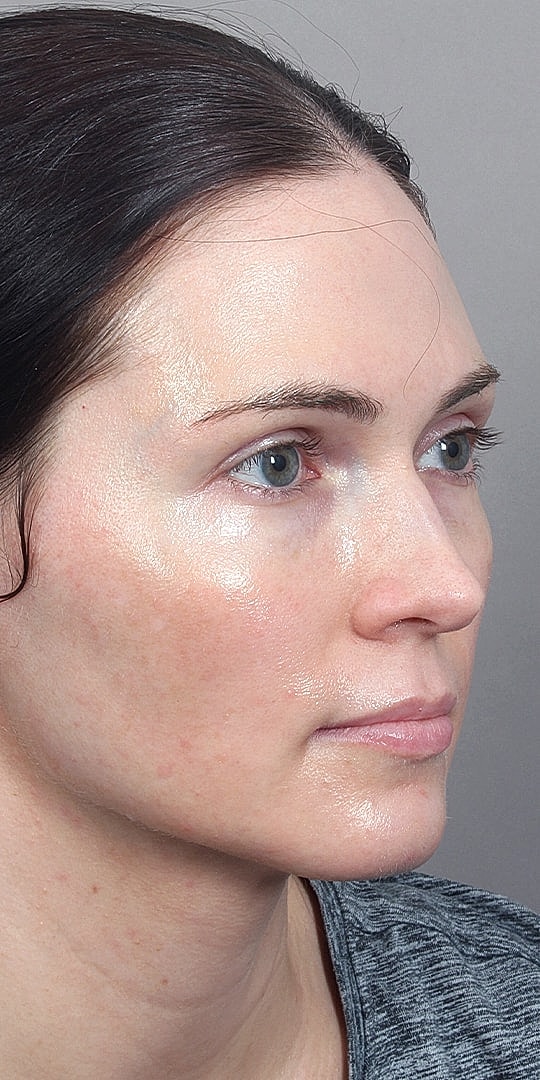 Facial Fat Transfer Before & After