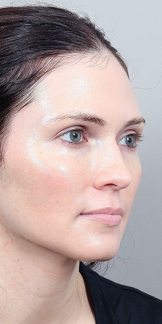 Facial Fat Transfer Before & After