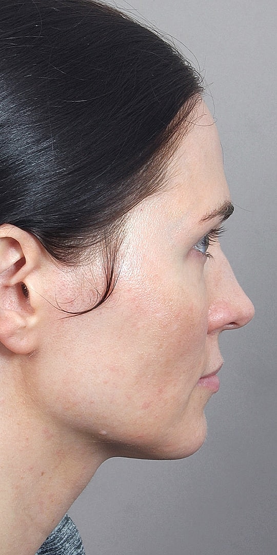 Facial Fat Transfer Before & After