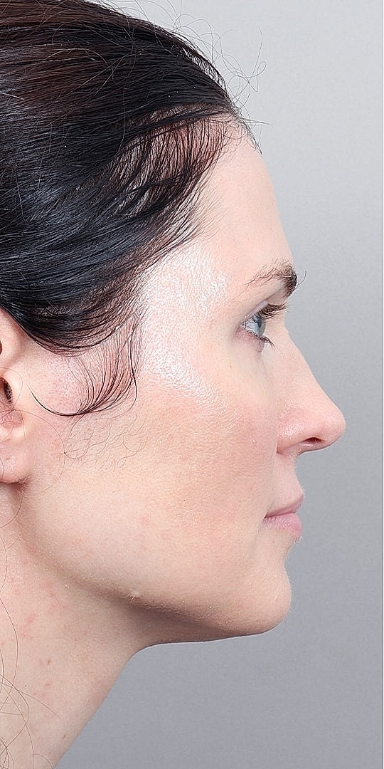 Facial Fat Transfer Before & After