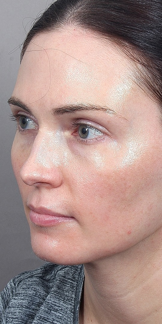 Facial Fat Transfer Before & After