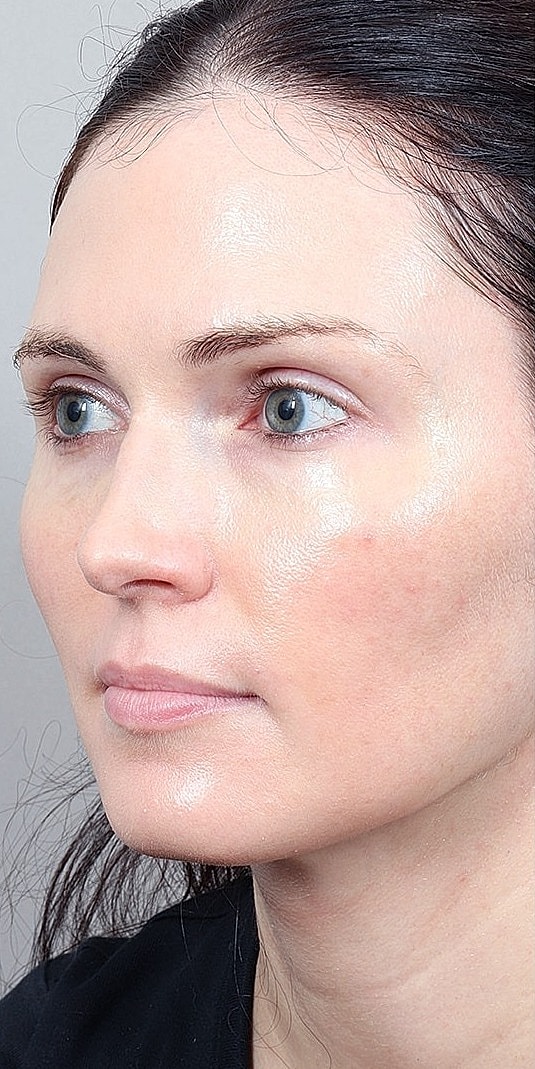 Facial Fat Transfer Before & After