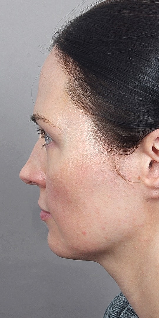 Facial Fat Transfer Before & After