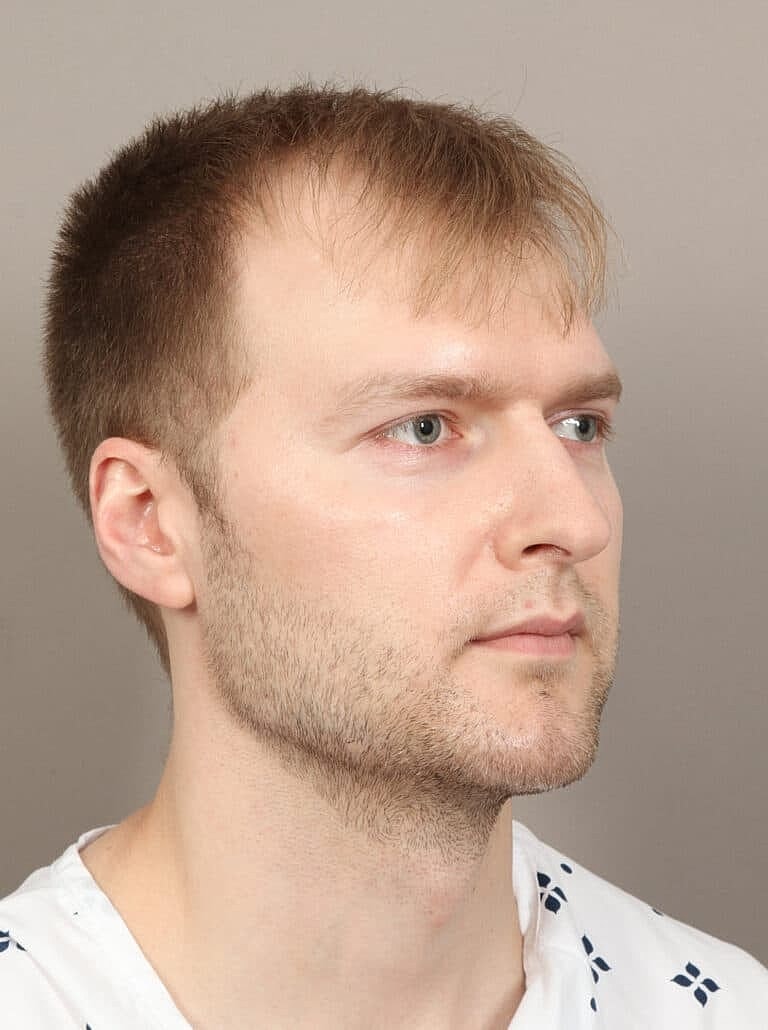 Chin Implant Before & After