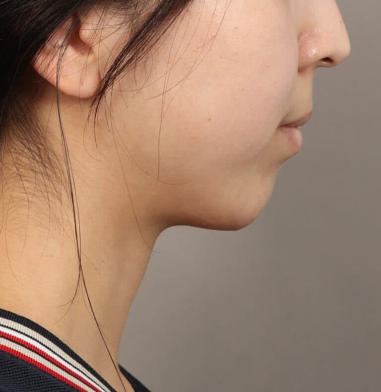 Chin Implant Before & After