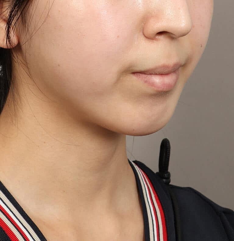 Chin Implant Before & After