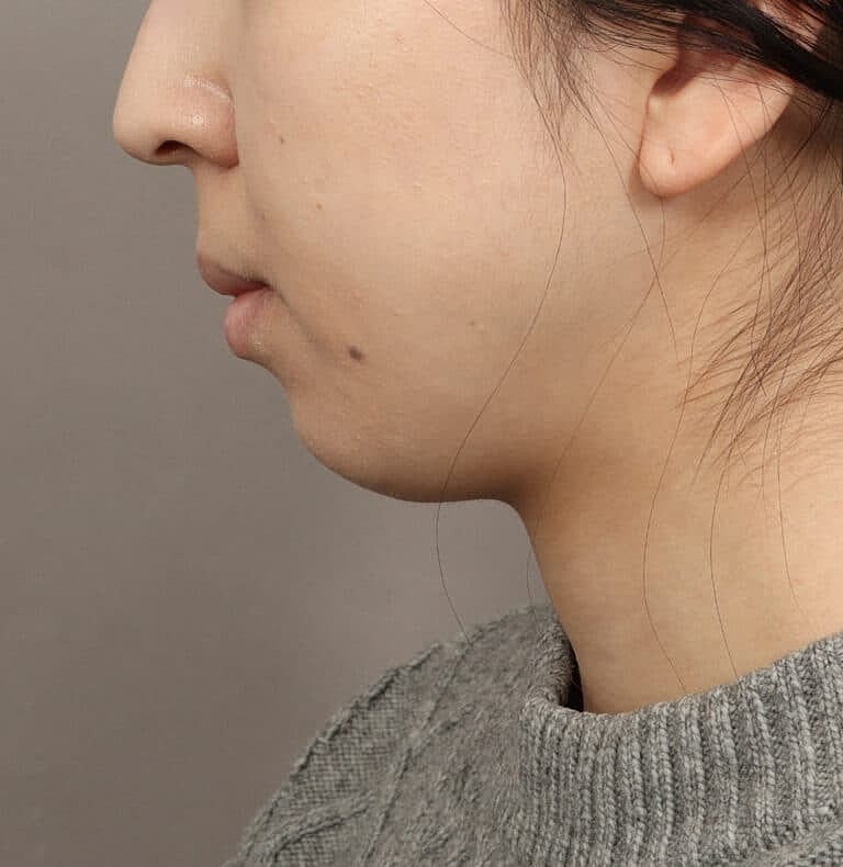 Chin Implant Before & After