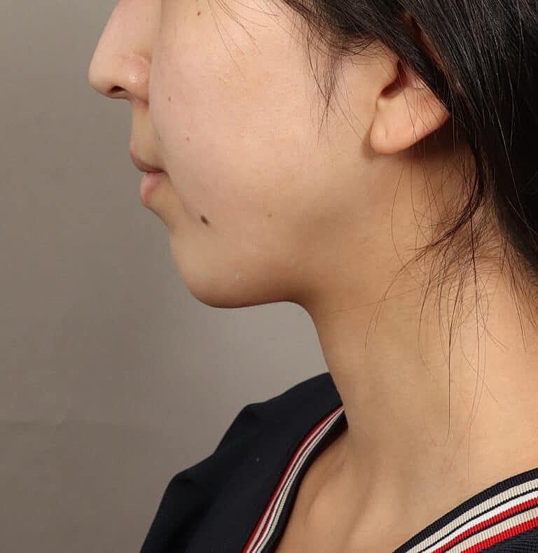 Chin Implant Before & After