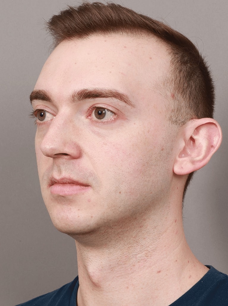 Chin Implant Before & After