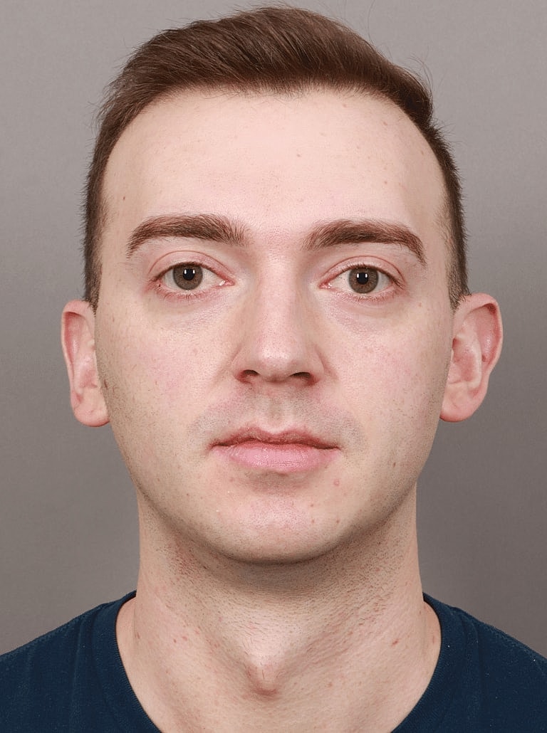 Chin Implant Before & After