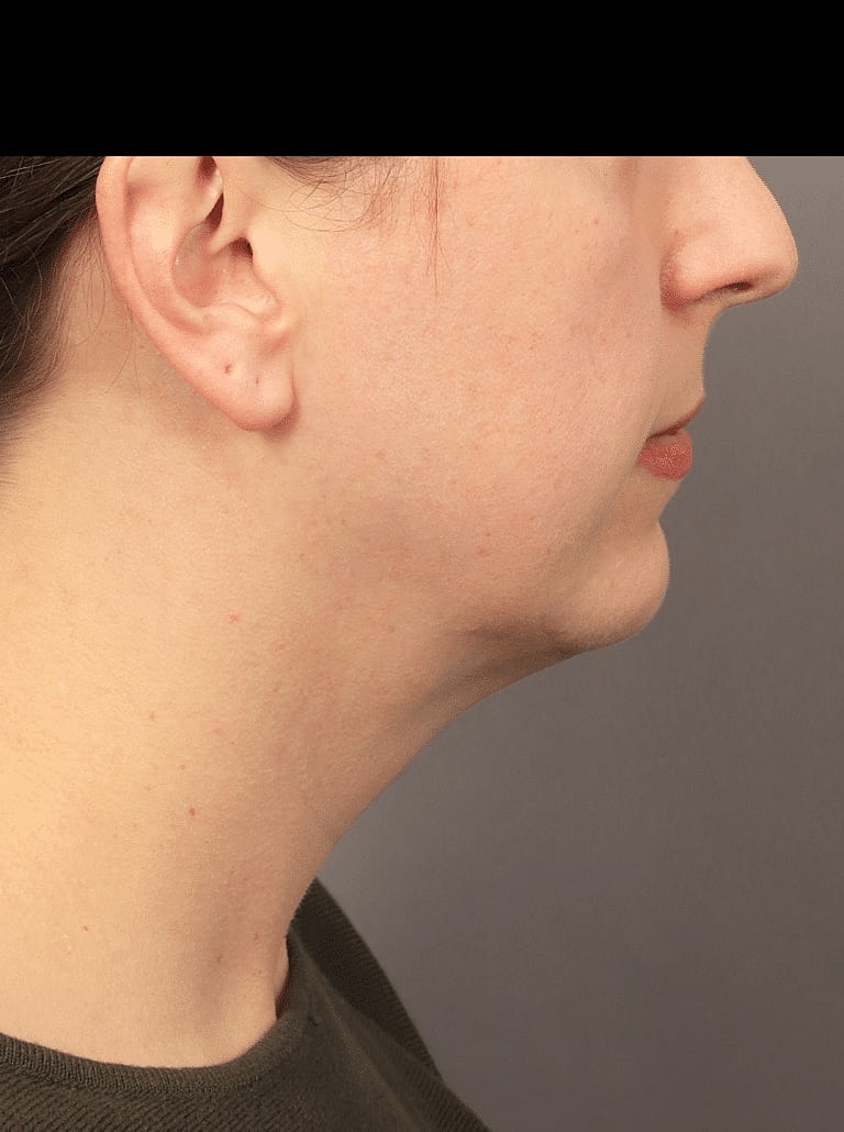 Chin Implant Before & After
