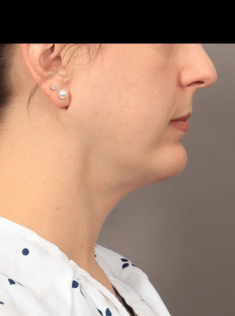 Chin Implant Before & After
