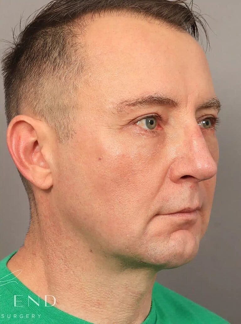 Chin Implant Before & After