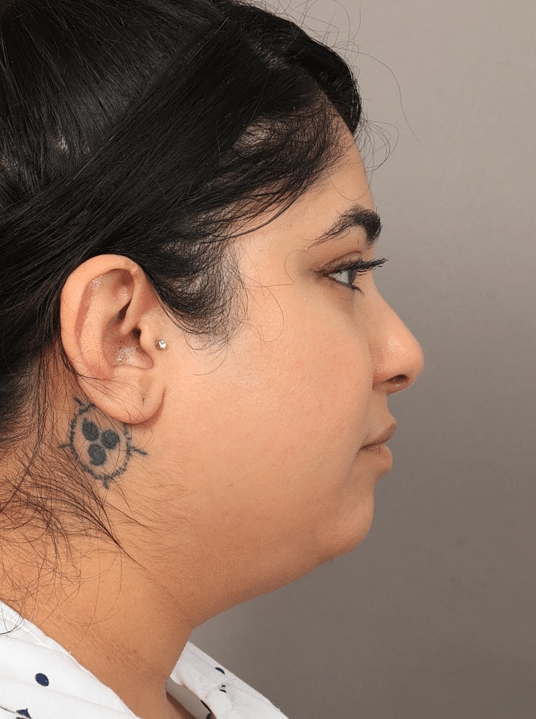 Chin Implant Before & After