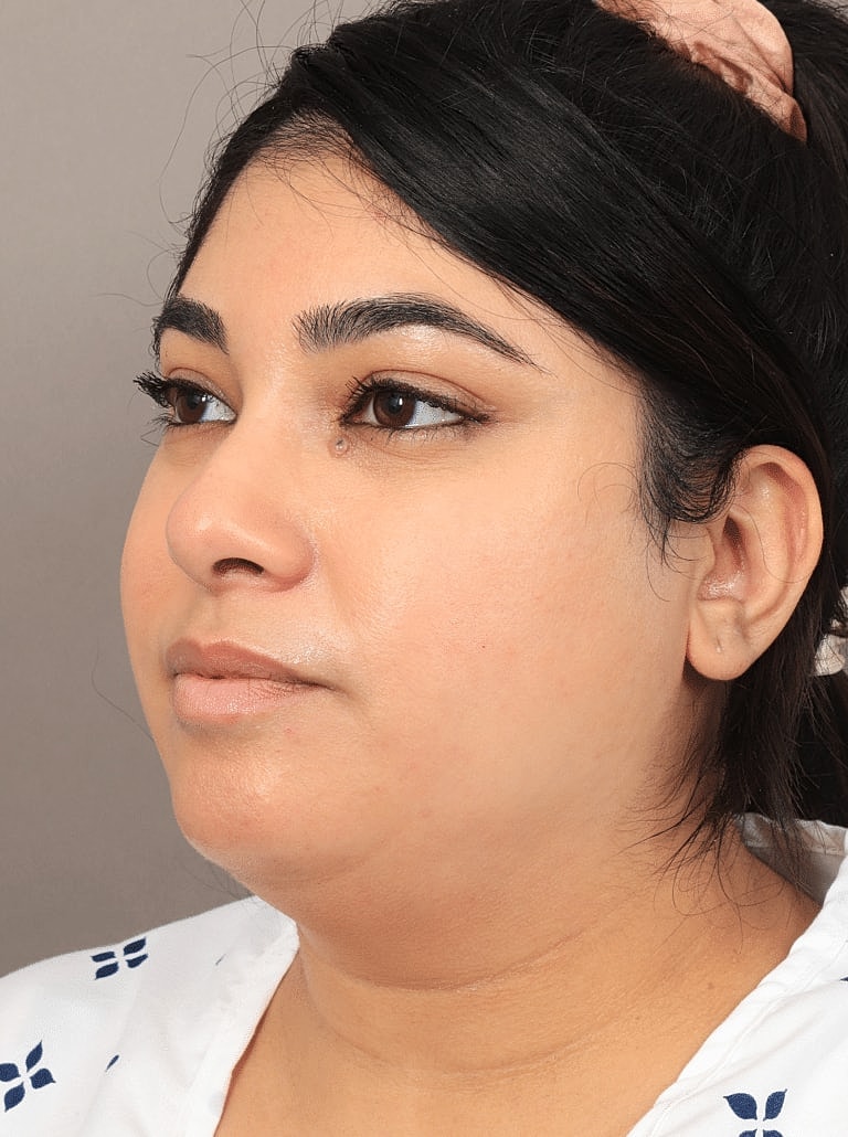 Chin Implant Before & After