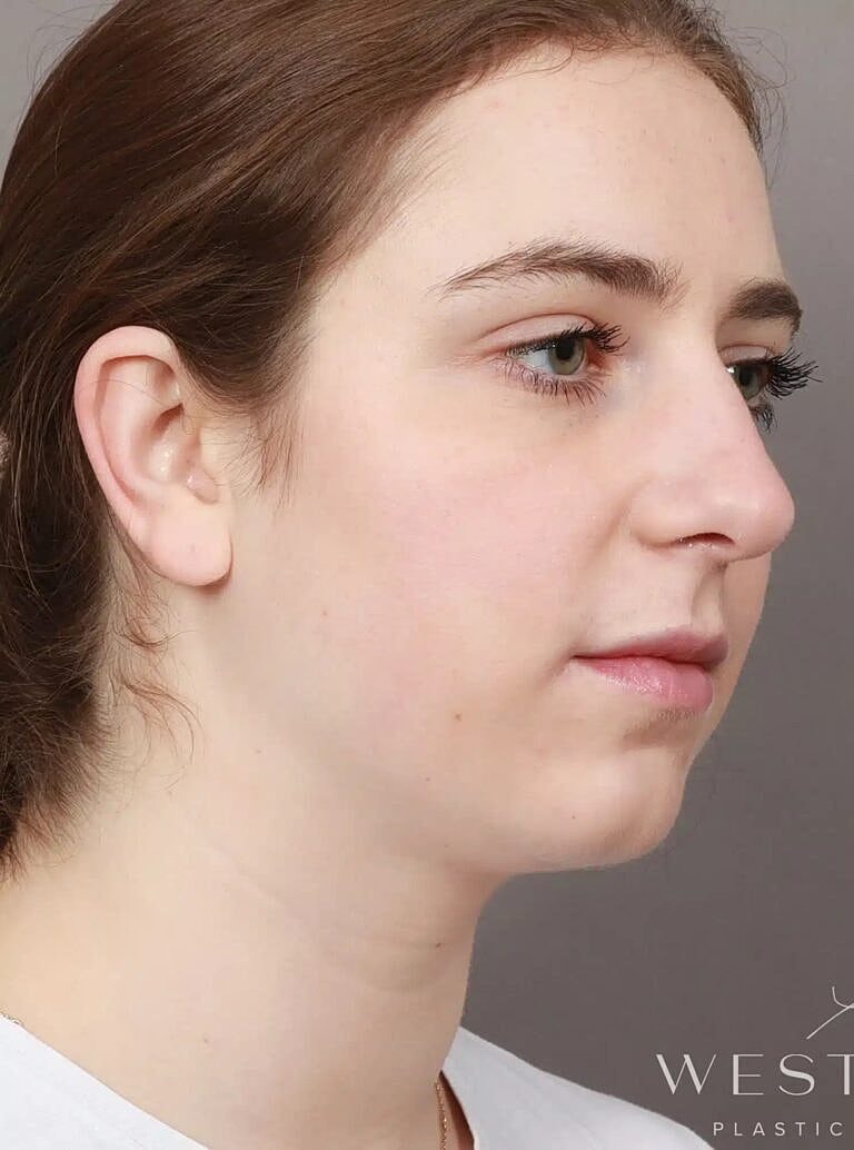 Chin Implant Before & After