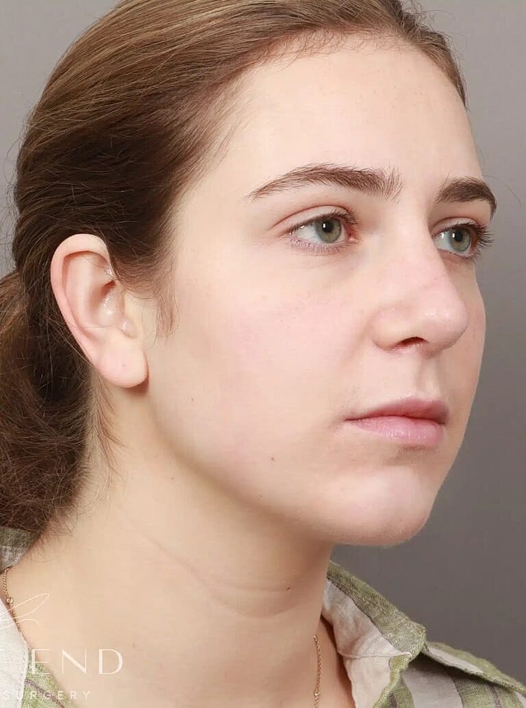 Chin Implant Before & After