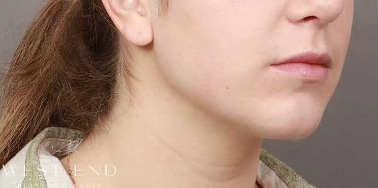 Chin Implant Before & After