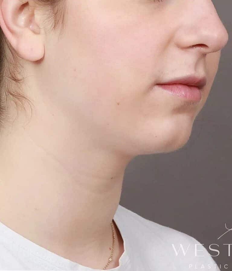 Chin Implant Before & After