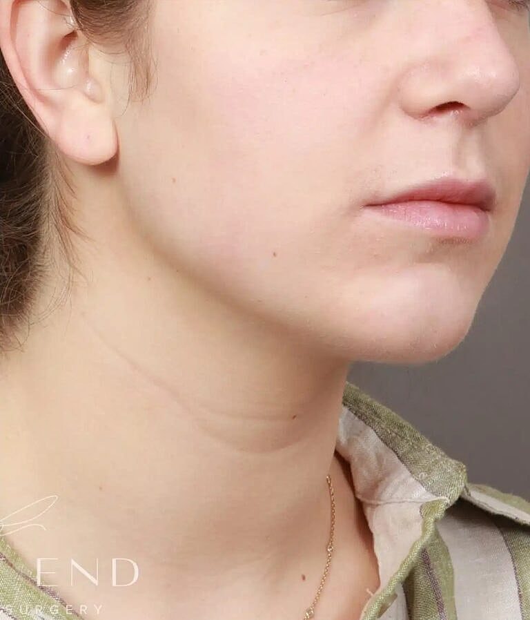 Chin Implant Before & After